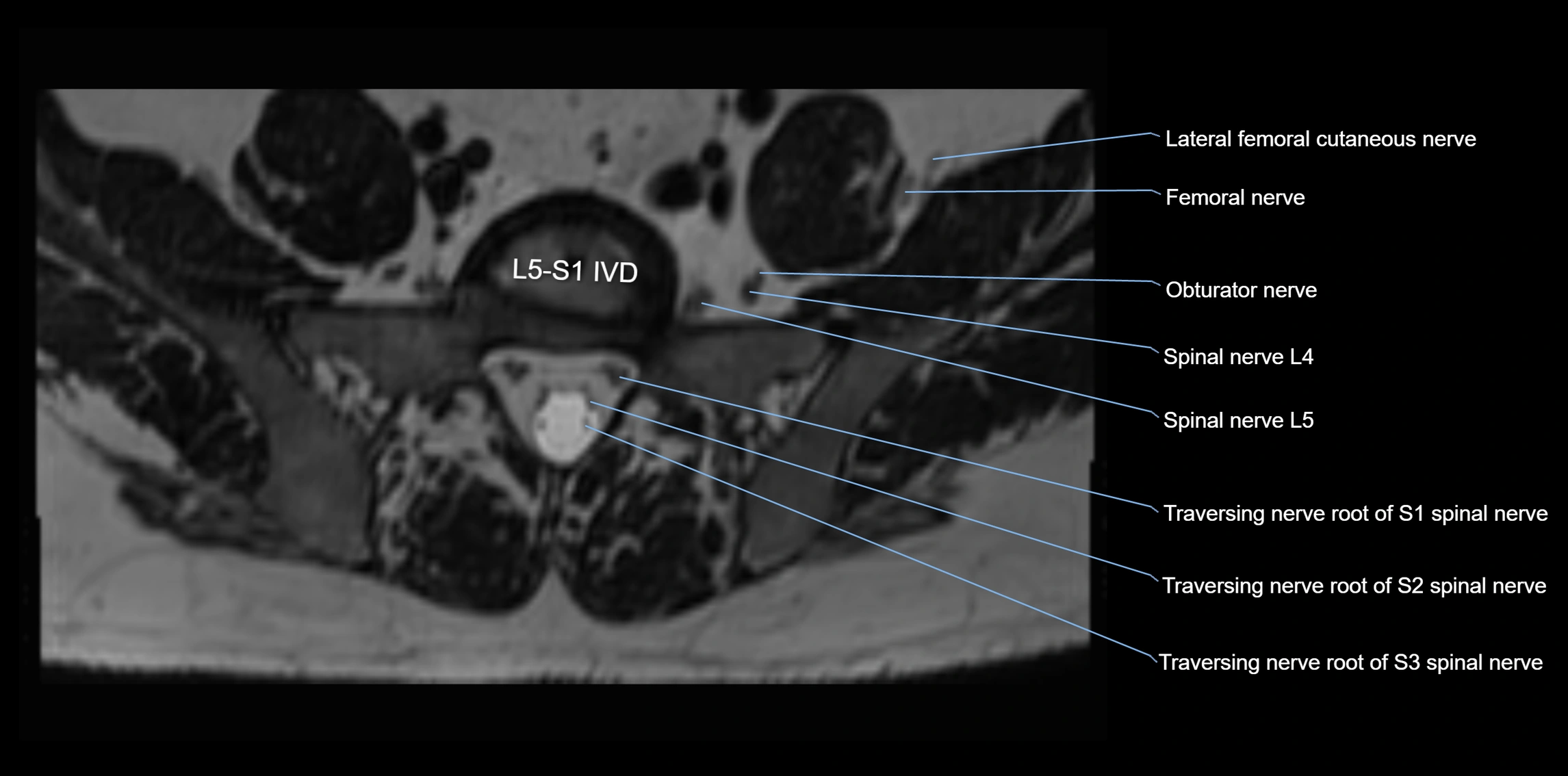 MR lumbosacral plexus axial cross sectional anatomy 3T  radiology  image-img-1008001-00066.webp